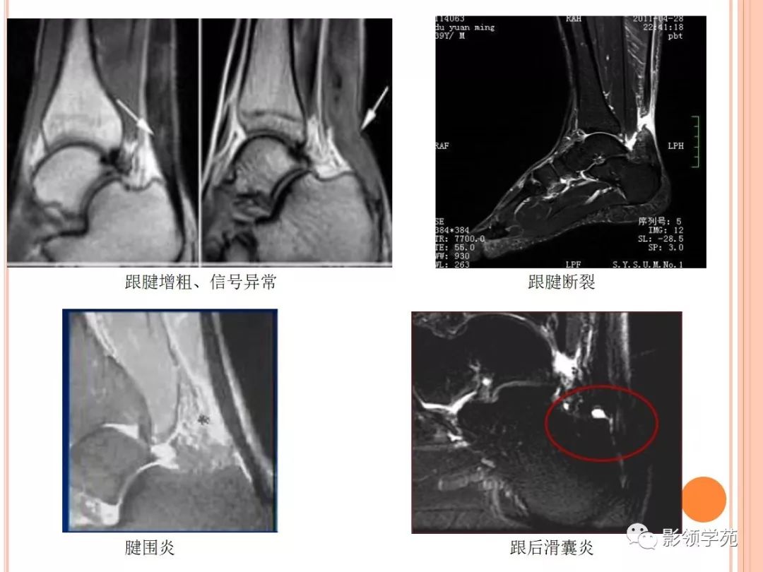 腱围炎(无腱鞘,可伴有跟后滑囊炎:mri表现为跟