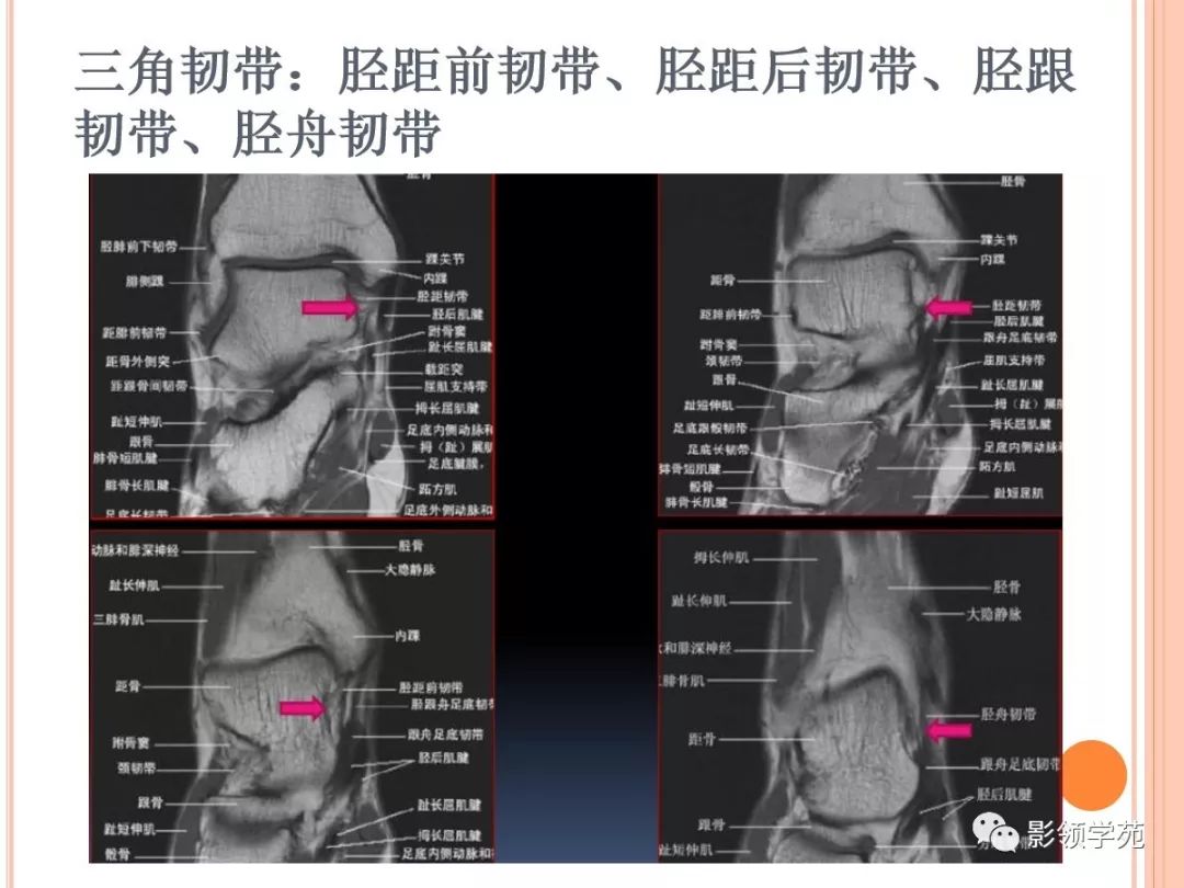 踝關節mri解剖和常見損傷類型