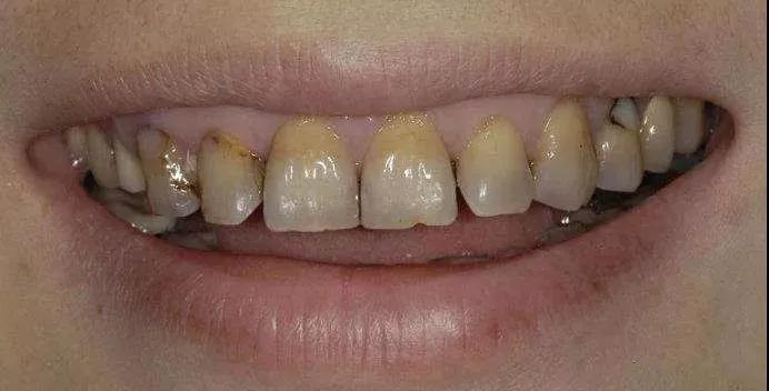牙齿为什么会变黄决不能让牙黄拖累我变美