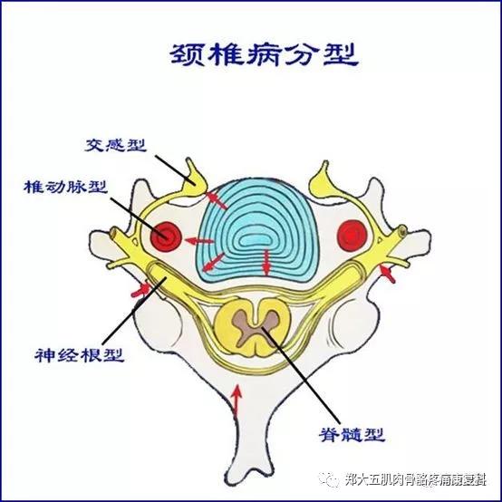 颈椎病分型4如先天性椎管狭窄,先天性椎体融合,颈肋和第7颈椎横突肥大