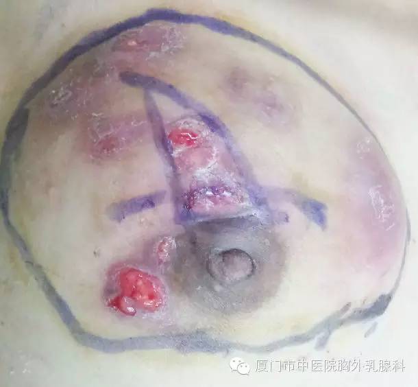 剪不断理还乱的非哺乳期乳腺炎