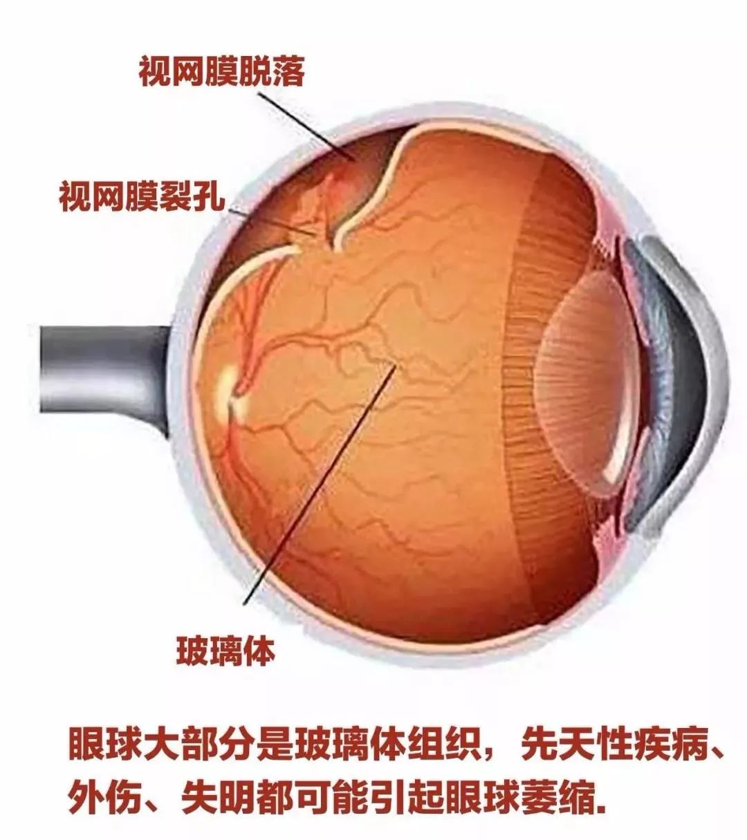 视网膜脱落危害大及时治疗挽回视力