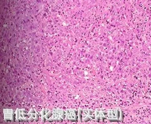 不出所料,病理结果出来了,低分化腺癌.