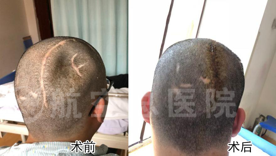 用peek和钛合金做颅骨修补手术的区别