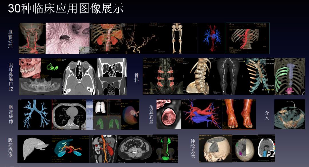 螺旋ct三维成像图片