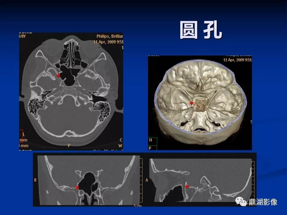 颅底ct骨窗解剖图谱图片