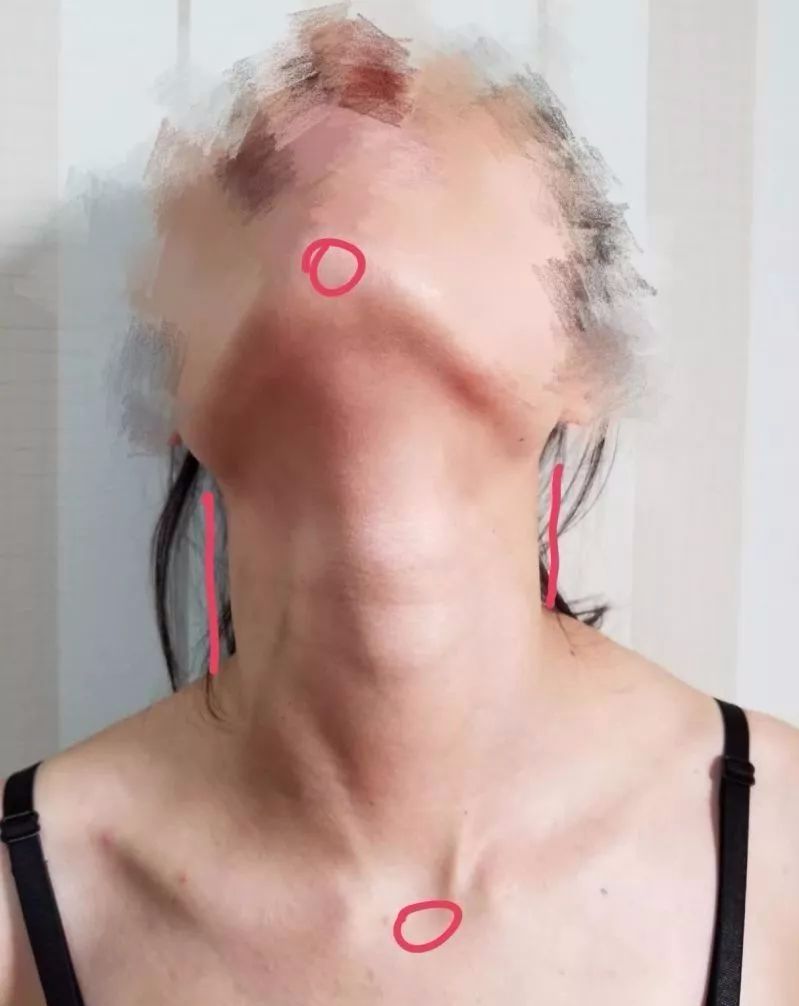女性右边锁骨下面疼痛图片