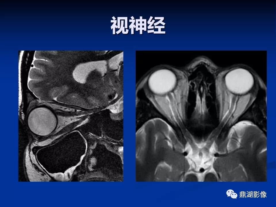 必點收藏 | 超詳細顱底影像解剖,千萬不要錯過