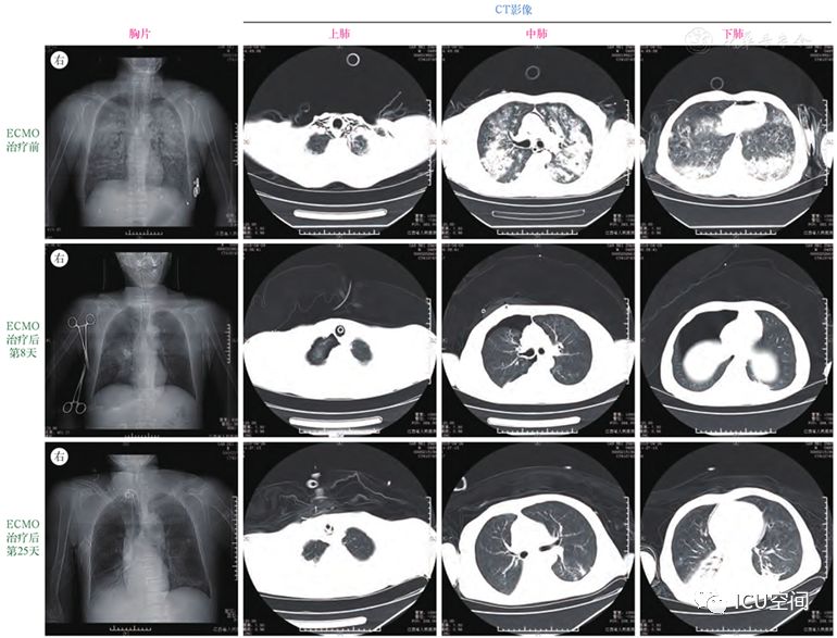 ecmo治疗急性光气中毒致急性呼吸窘迫综合征附4例报告