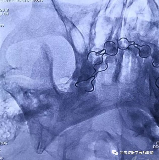 卵圆孔x线影像图片