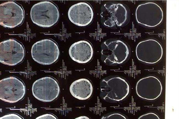 新生儿脑水肿严重吗新生儿脑水肿会影响发育吗