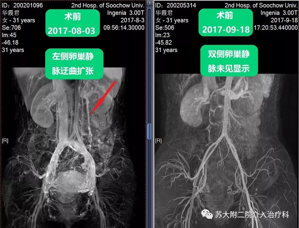 患者术前mrv显示左侧卵巢静脉增粗显影伴有子宫周围静脉增粗,曲张