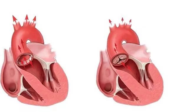 主动脉瓣膜位于主动脉根部与心脏连接处,呈软质三瓣式结构,心脏压出