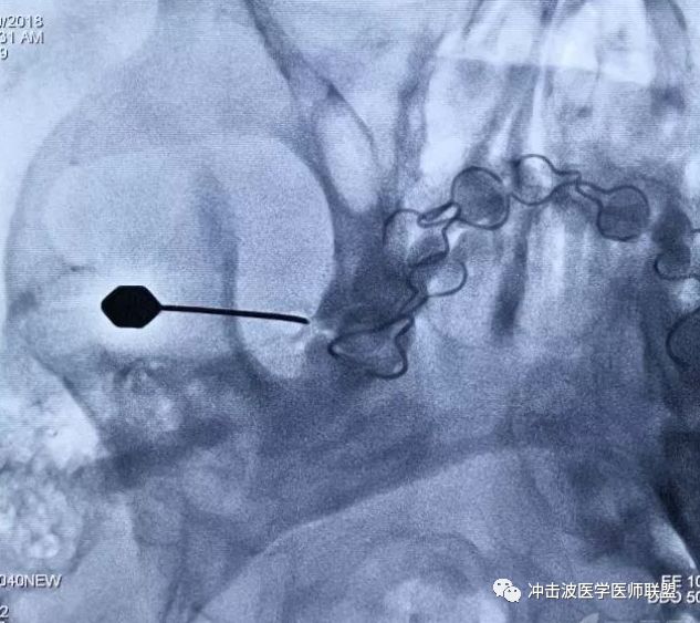 卵圆孔x线影像图片