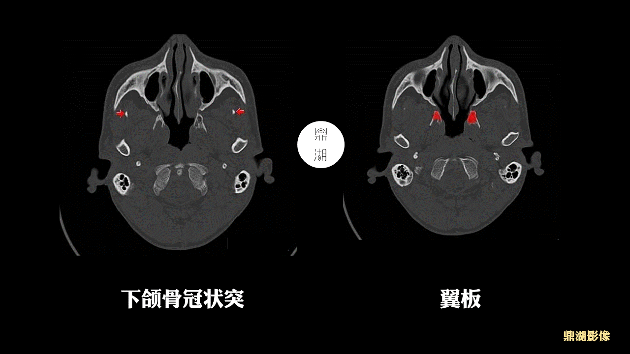 超精致颅底断层解剖(必点收藏)