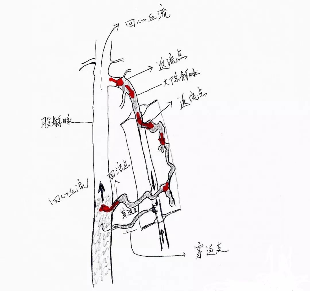 缩写,意为"基于血流动力学保留静脉治疗下肢静脉功能不全的日间手术"
