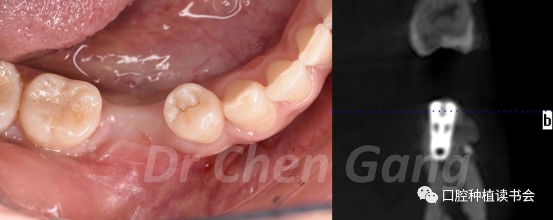 骨再生案例大赏 后牙区种植的软硬组织重建 骨膜