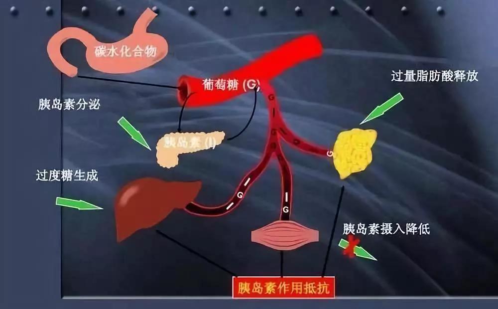 是多种原因导致胰岛素抵抗或胰岛分泌不足,如果胰岛素利用率降低了