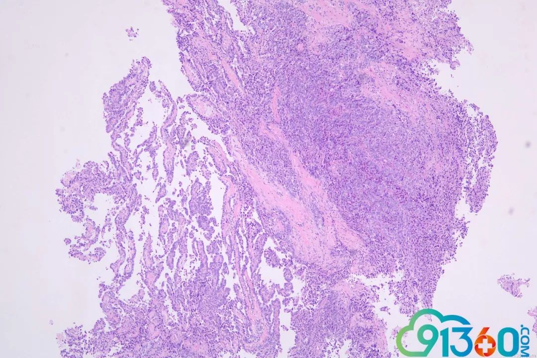 卵巢高级别浆液性癌