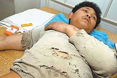 萍乡一炼钢工人被千度钢水烧伤致残妻子毅然决定离婚