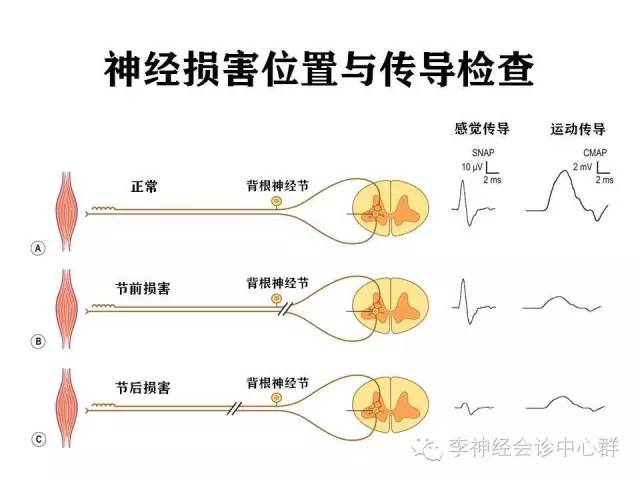 所以出脊髓後任何一個位置的損害,都會導致遠端運動纖維和運動神經元