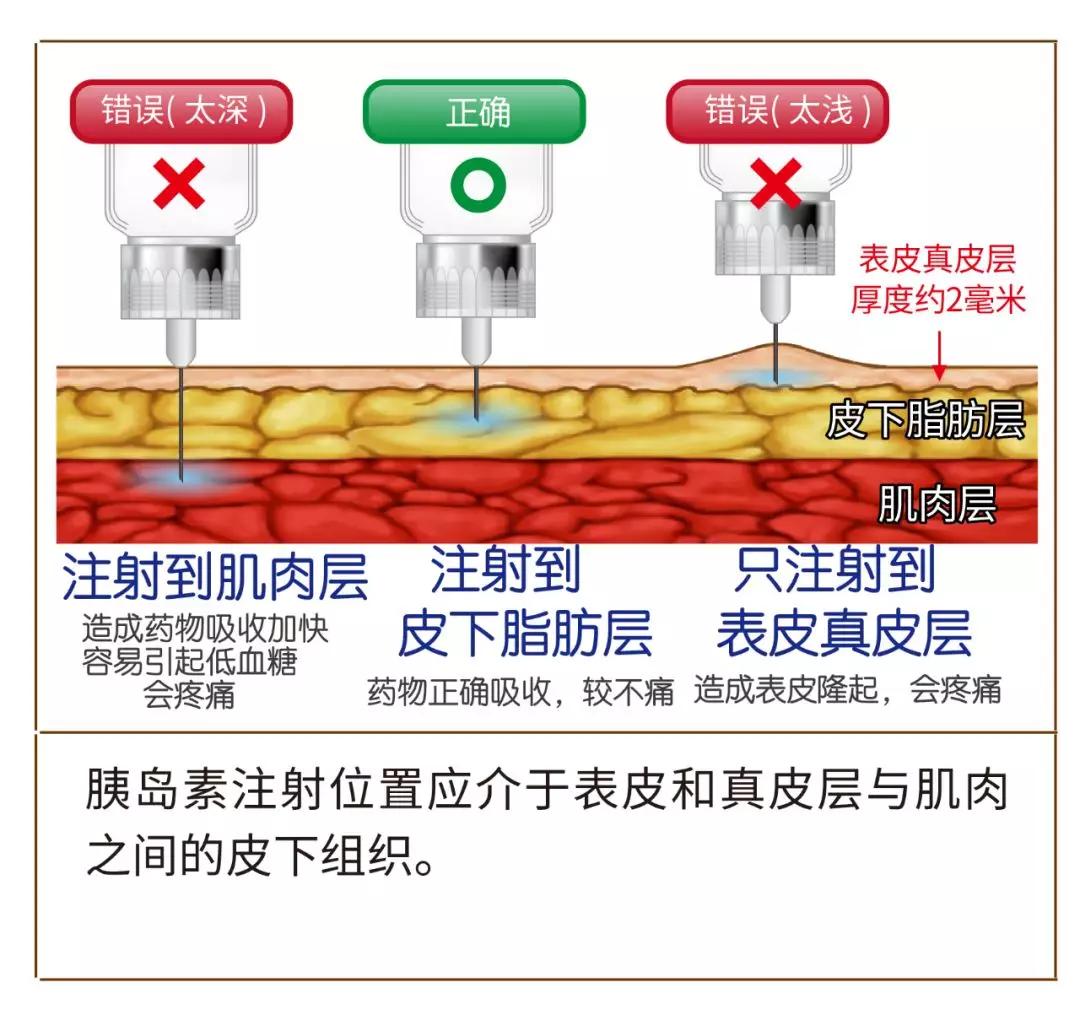 利拉鲁肽注射位置图片图片