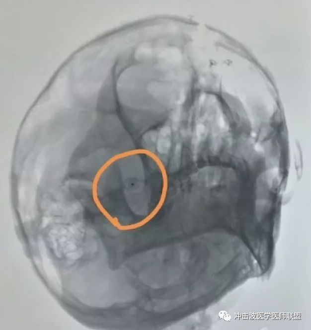 卵圆孔x线影像图片