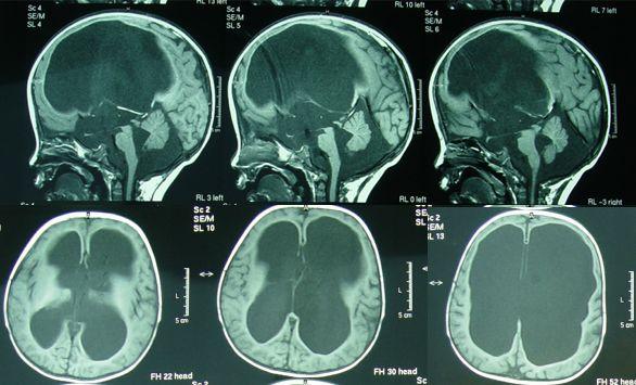 婴儿脑积水怎么治疗好婴儿脑积水治疗的方法