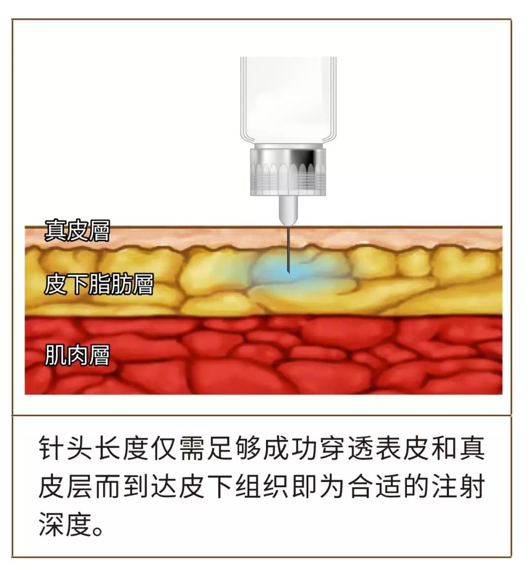 以避免发生脂肪代谢障碍(脂肪增生或脂肪萎缩)为使胰岛素的作用达到更