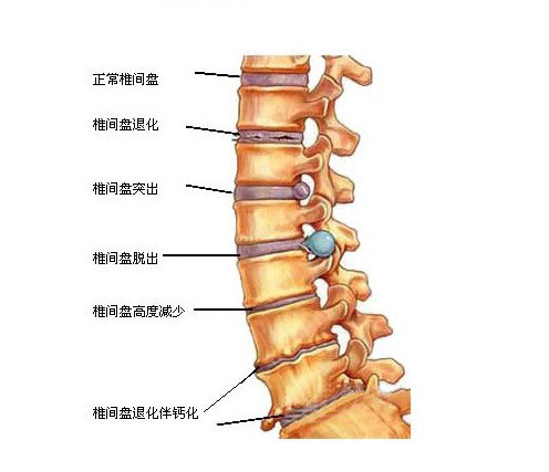 脊柱是一个重要的人体躯干的支撑,包括脊髓神经以及骨性结构,脊髓的颈