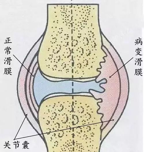 膝关节积液治疗方法图片