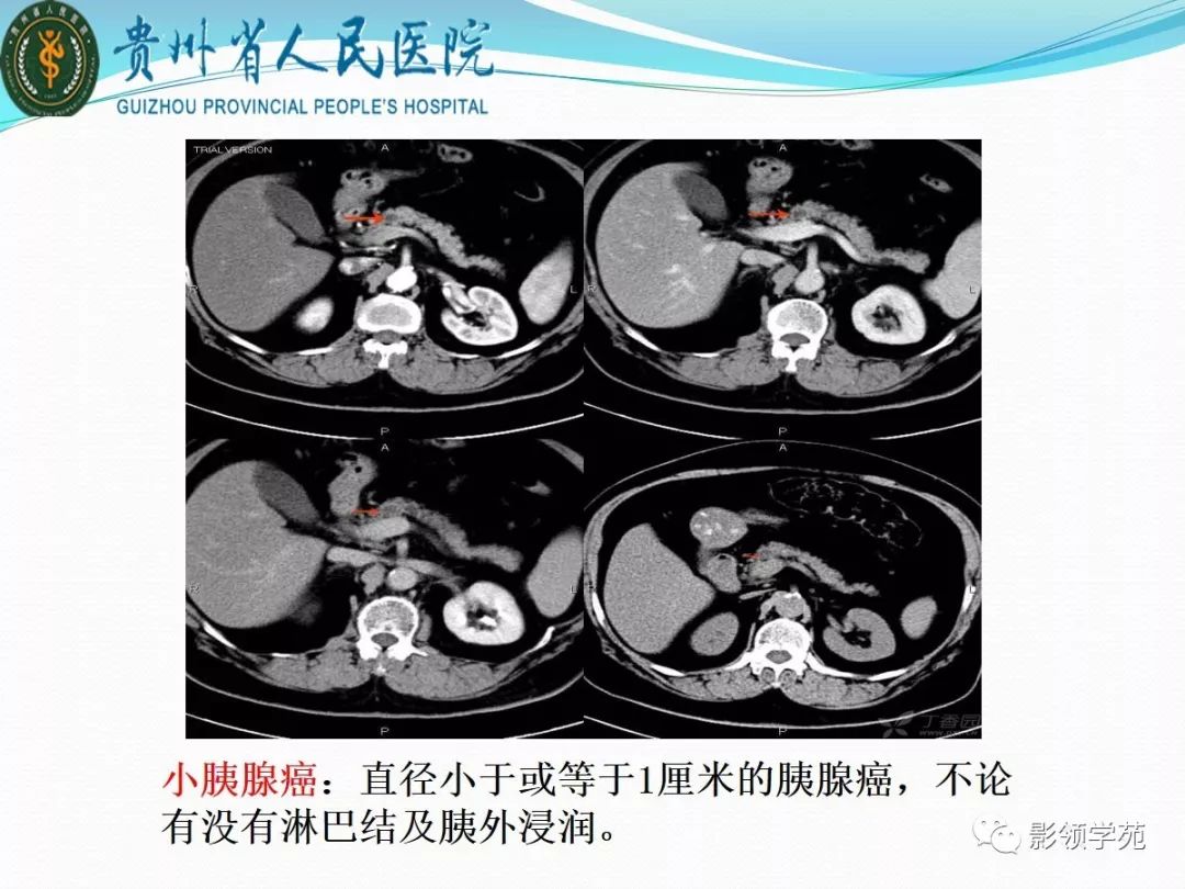 胰腺常見原發腫瘤的ct表現