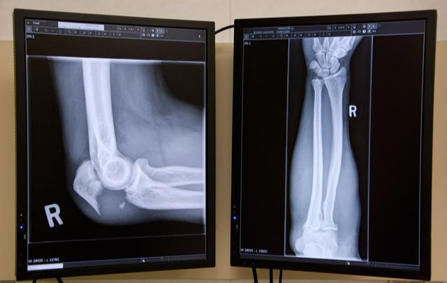 什么是网球肘得了网球肘该怎么办