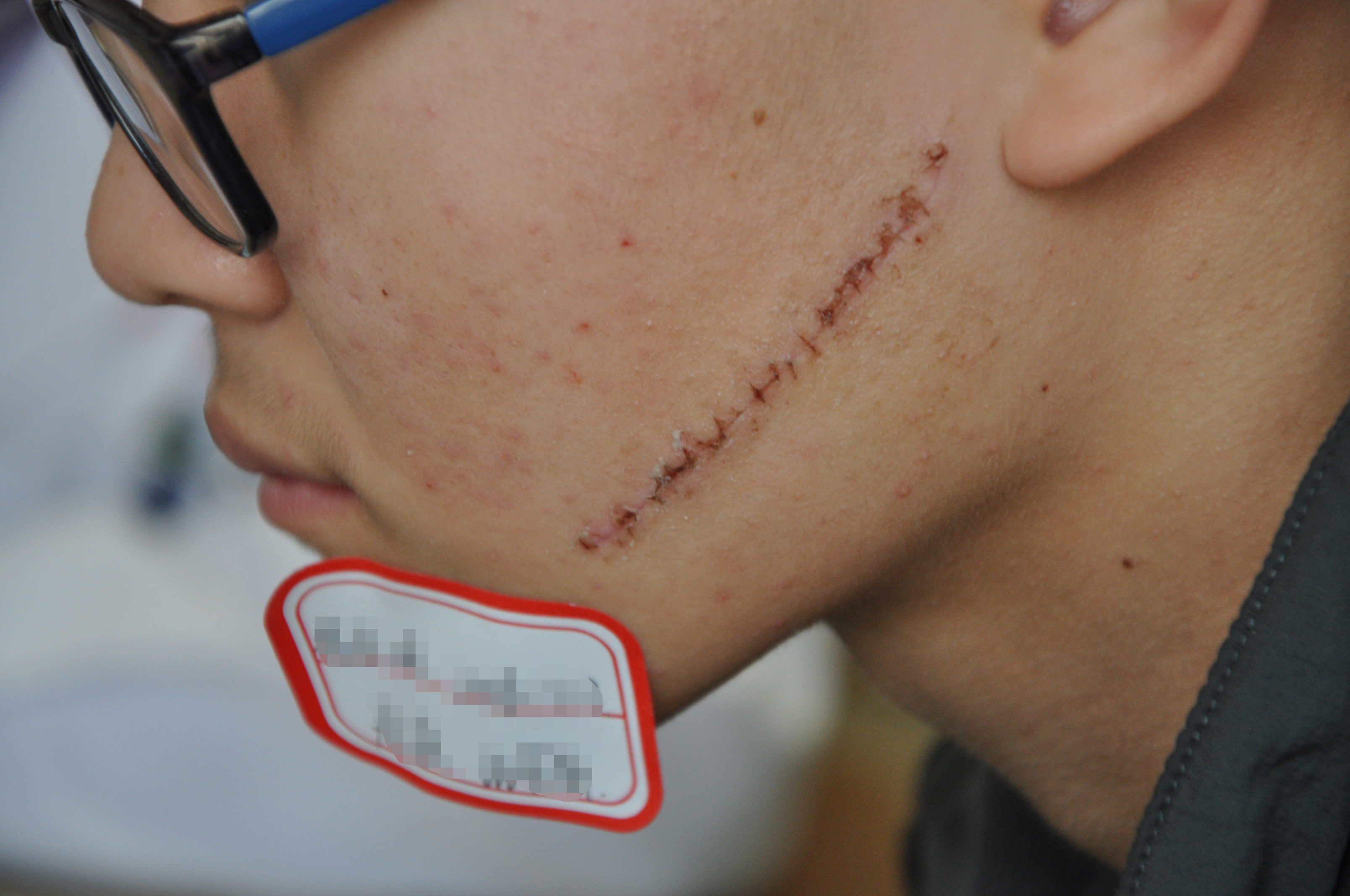 上海长江医院告诉你浅表性疤痕的护理和治疗