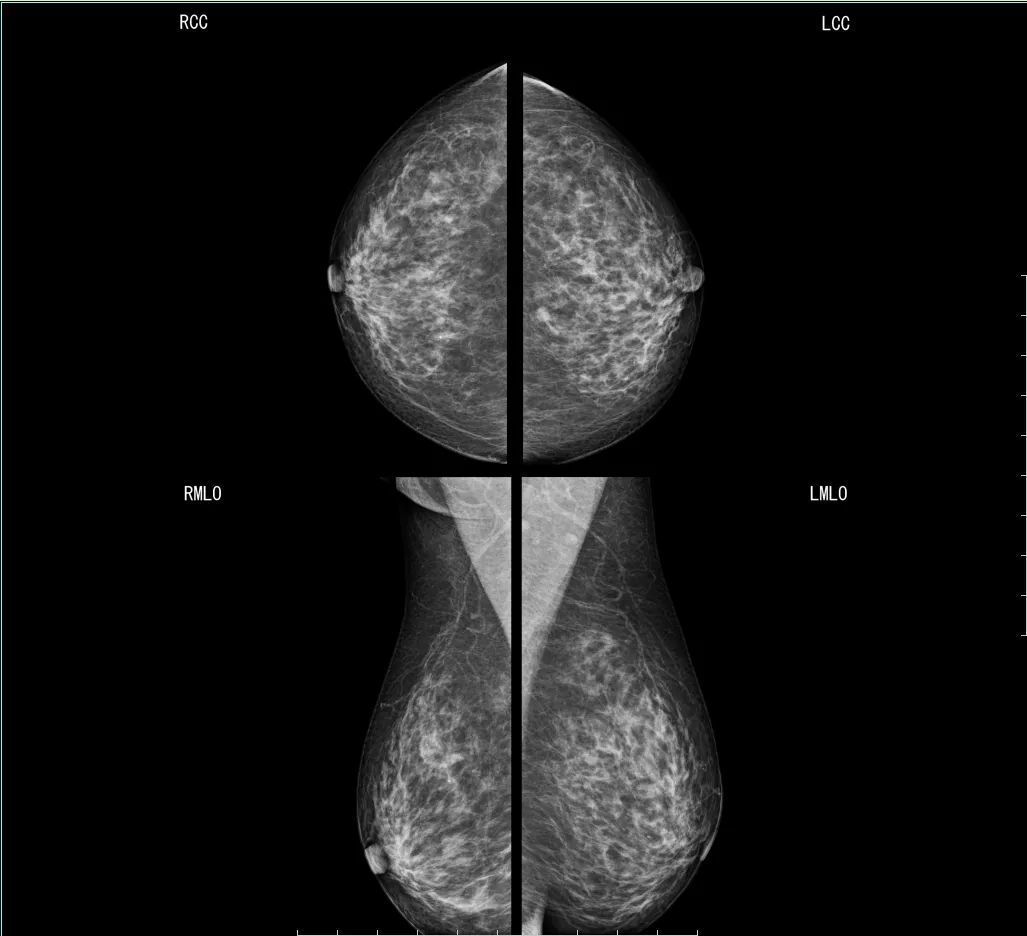 乳腺钼靶中央区位置图图片