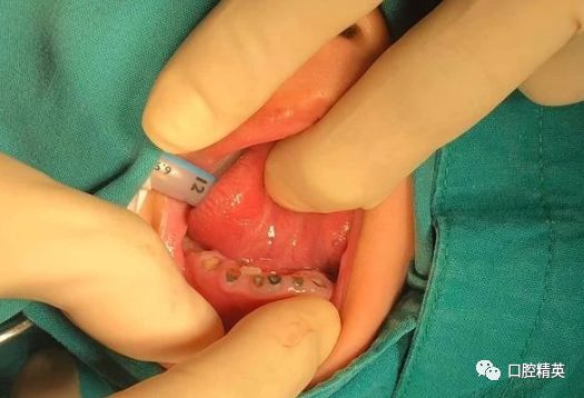 4岁男童拔光20颗乳牙保护宝宝牙齿这些食物再馋也不能吃