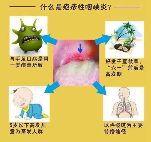 儿童疱疹性咽峡炎过程图片