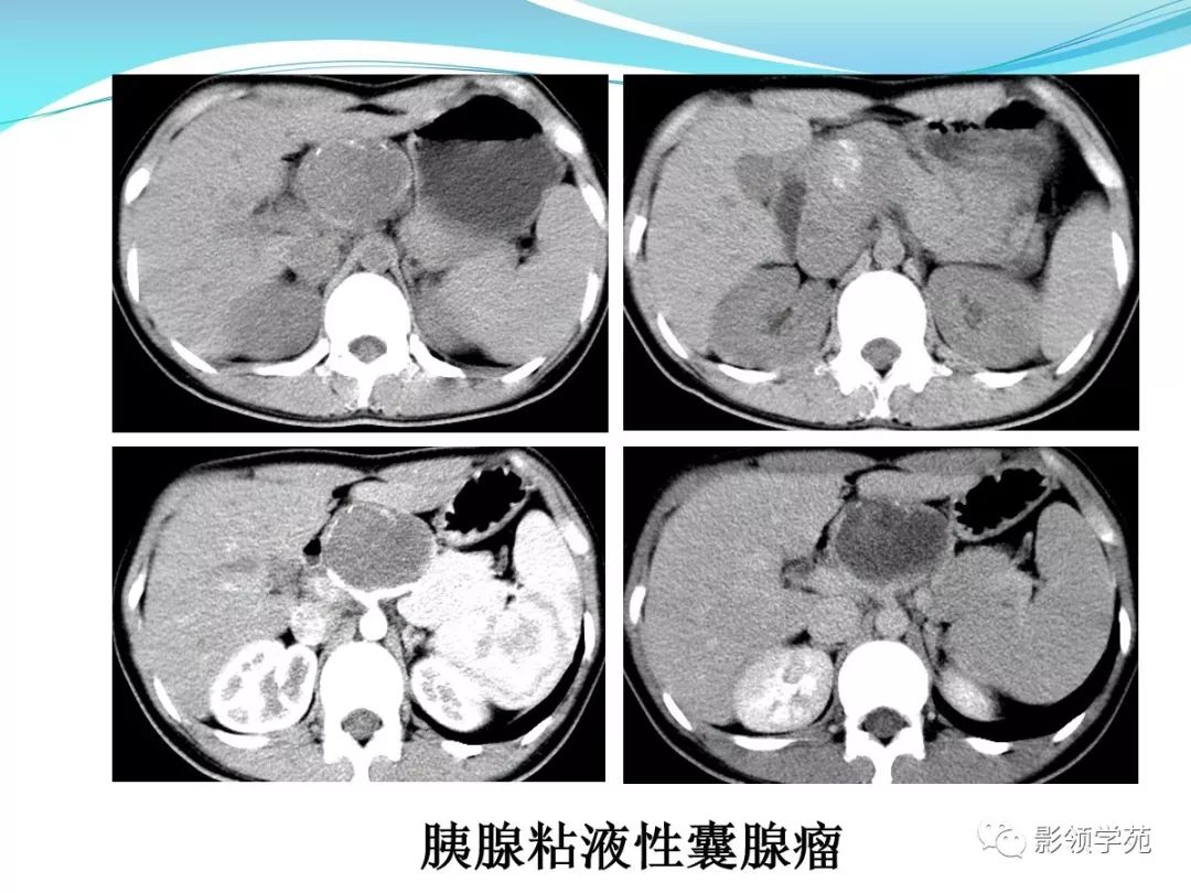 16岁,术后病理证实:实性假乳头状瘤由杨学东老师主讲的胰腺囊性病变的