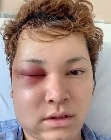 男偶像感冒一个月无法治愈经检查患怪病做手术脸毁容每天寻死