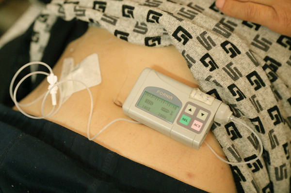 4%,同一部位持续胰岛素泵输注≤3d的病人皮下硬结发生率为8.6%.