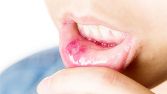患上口腔溃疡钻心的痛这种常见的植物就能治1天立刻见效