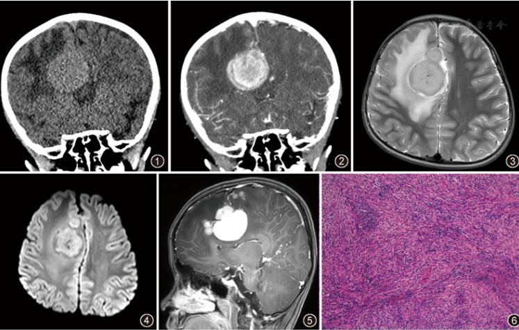 【病例报告】儿童右额叶炎性肌纤维母细胞瘤一例