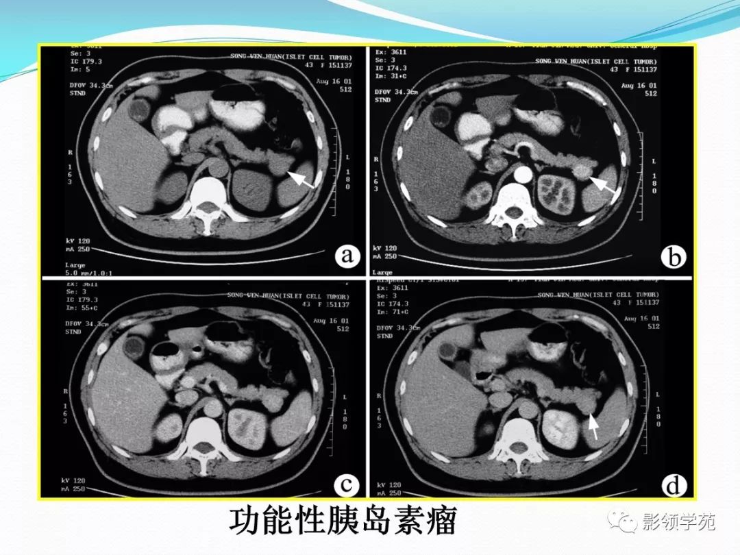 胰腺常见原发肿瘤的ct表现