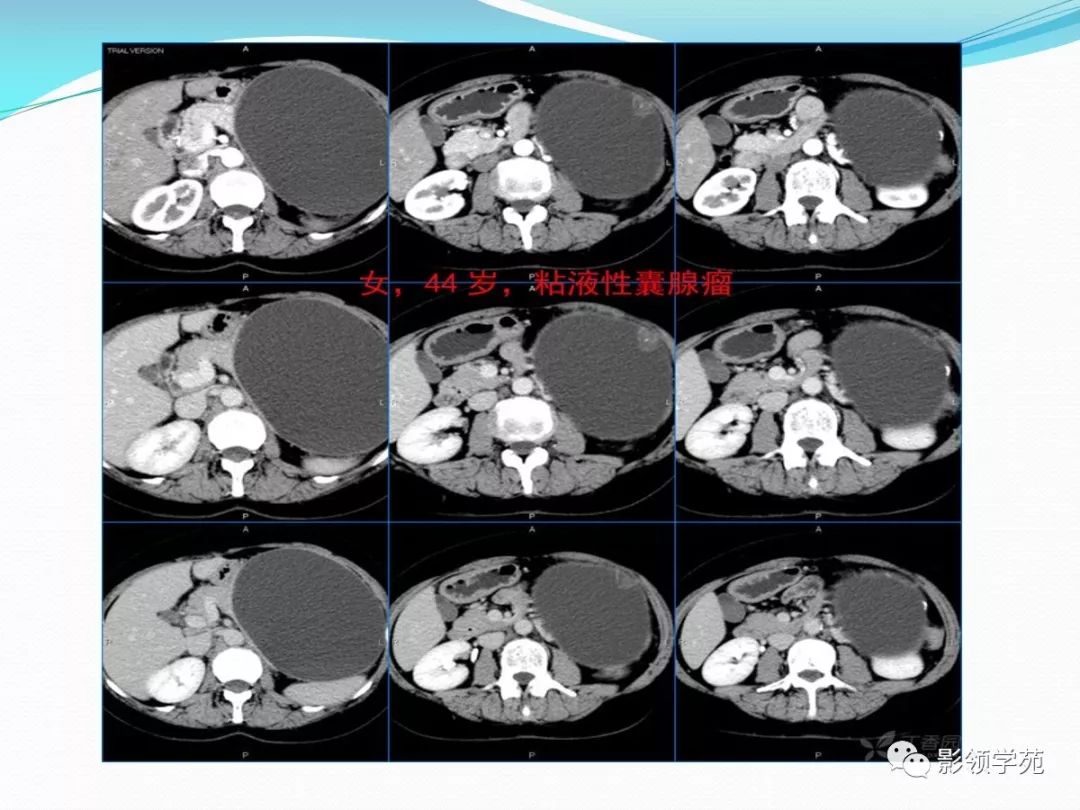 胰腺常見原發腫瘤的ct表現