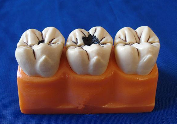 窝沟封闭和补牙有什么区别?要注意哪些事项?医生来告诉你