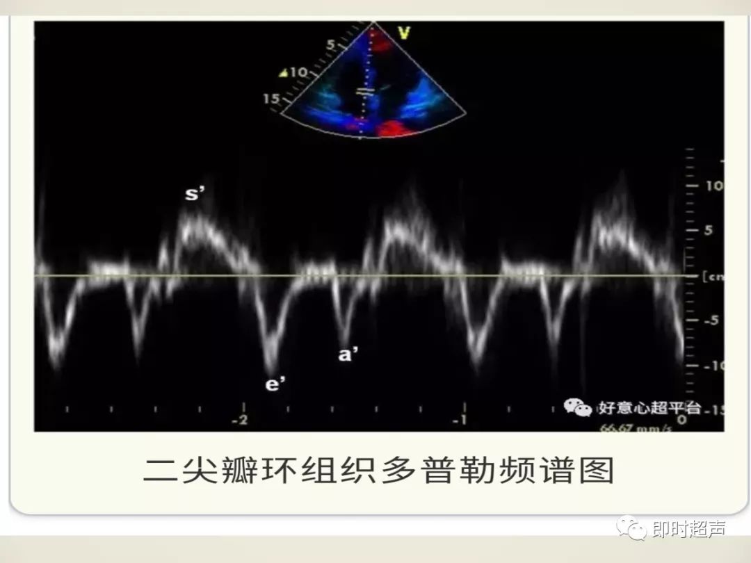 超声心动图评估左室舒张功能