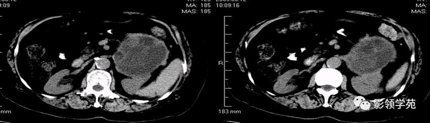 胰腺粘液性囊腺癌 作者：贵州省人民医院放射科 唐雷 影胰尾部粘液性囊性癌 女，16岁，术后病理证实：
