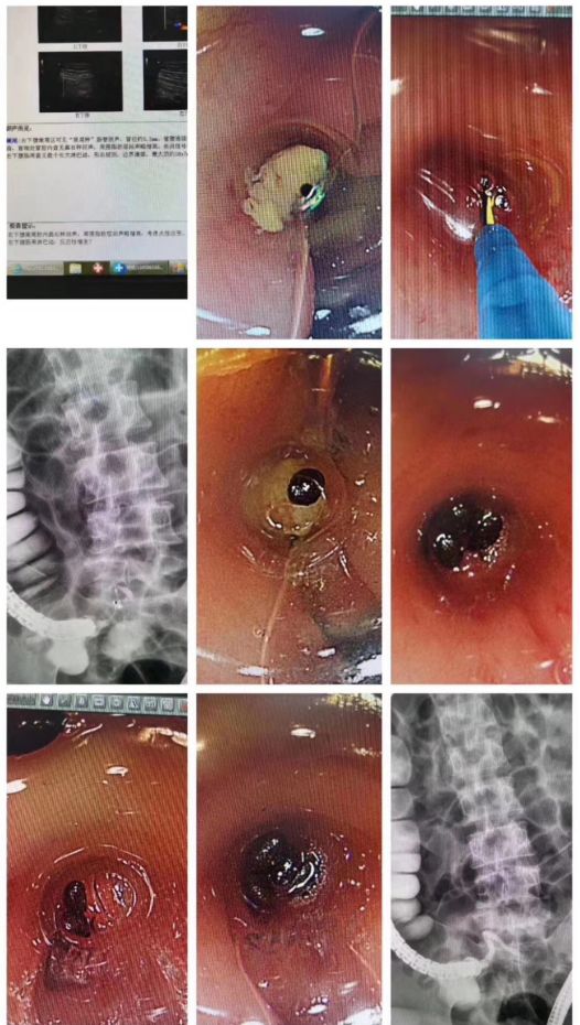 也治疗好了阑尾炎,还掏出了"以猕猴桃籽为主的粪石"……症状缓解,心情
