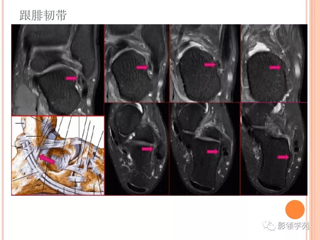 踝關節mri解剖和常見損傷類型