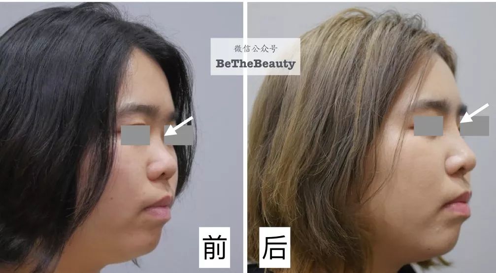 但  垫山根对底子要求很高,效果好的,基本是  本身额头高鼻尖高,只是